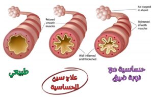 الإهمال في علاج حساسة الصدر يؤدي إلى تغيرات مزمنة في أنسجة الشعب الهوائية